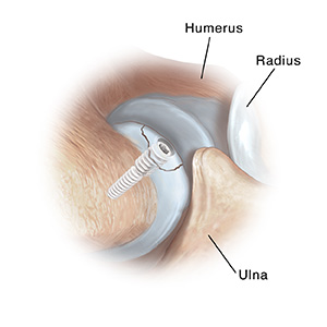 Side view of elbow joint showing screw holding loose cartilage in place.