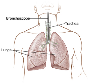 Front view of male chest showing flexible bronchoscopy.