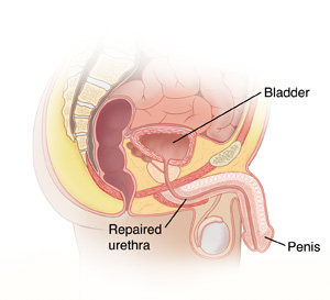 Side view cross section of male anatomy showing intestines, rectum, bladder, prostate, penis, testis, urethra, and repaired urethra.